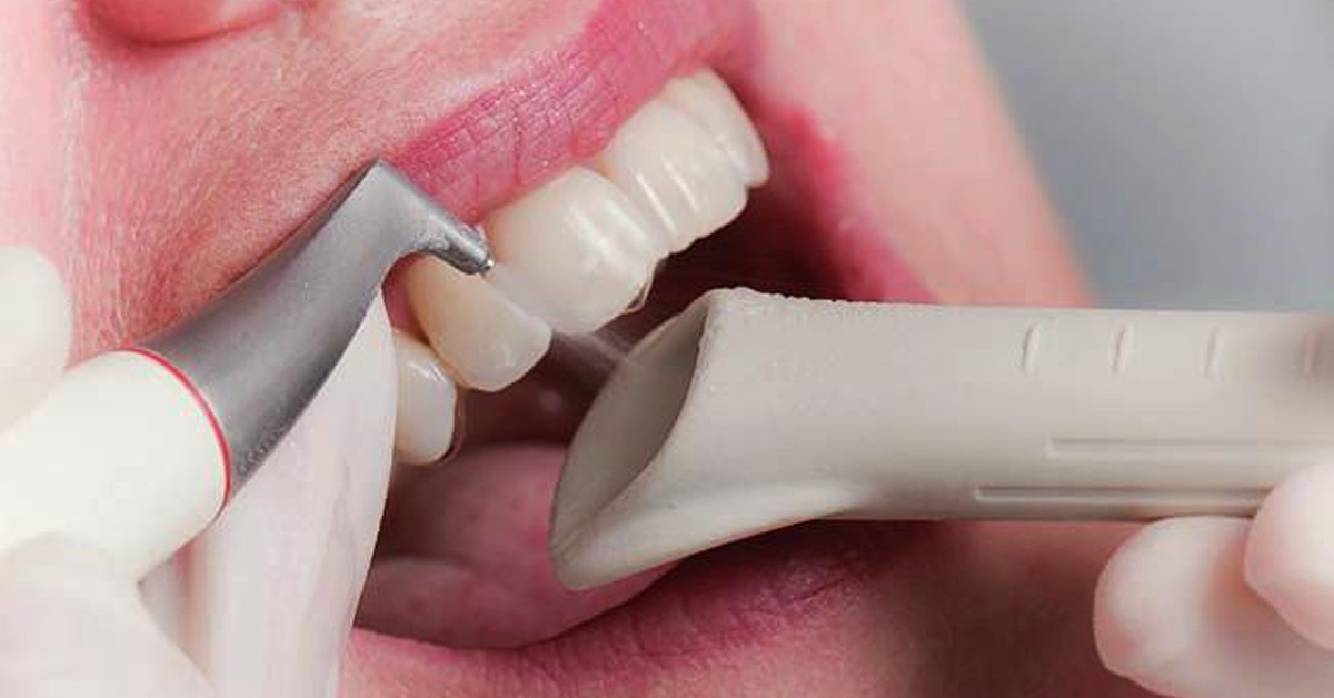 Mit jelent a homokfúvás kezelés a fogászatban?